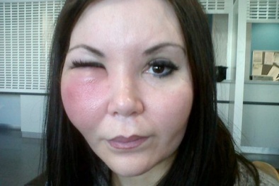 Làm đẹp không dao kéo: 'Cú' chẳng hóa 'tiên' lại mất tiền!